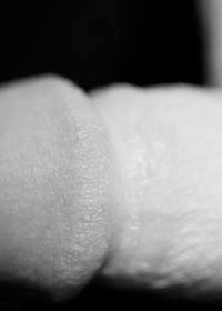 Penile papules white Pearly Penile