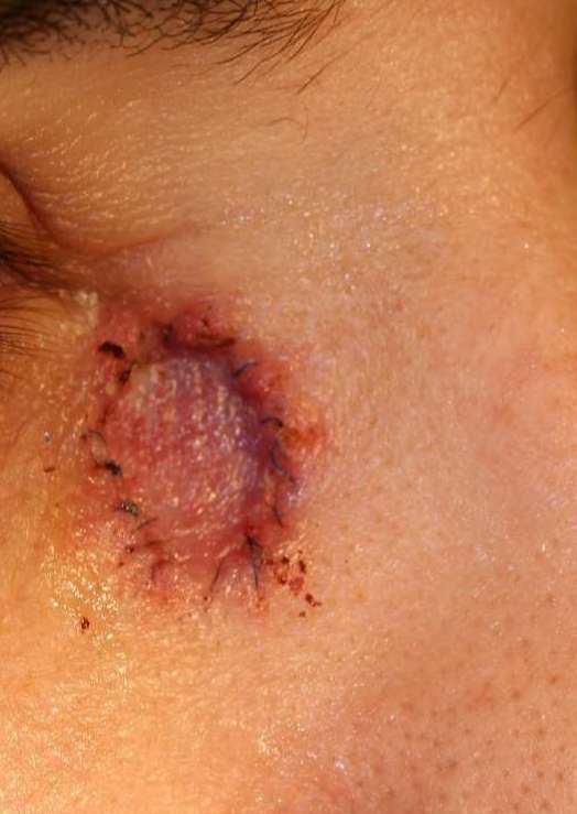 Skin cancer removal near eye