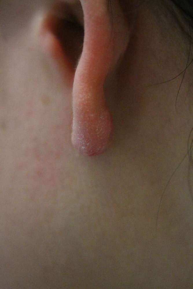 Keloid scarring earlobe after treatment