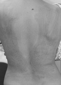 Tattoo removal - whole back