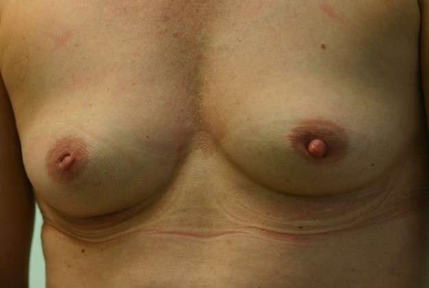 Breast enlargement 