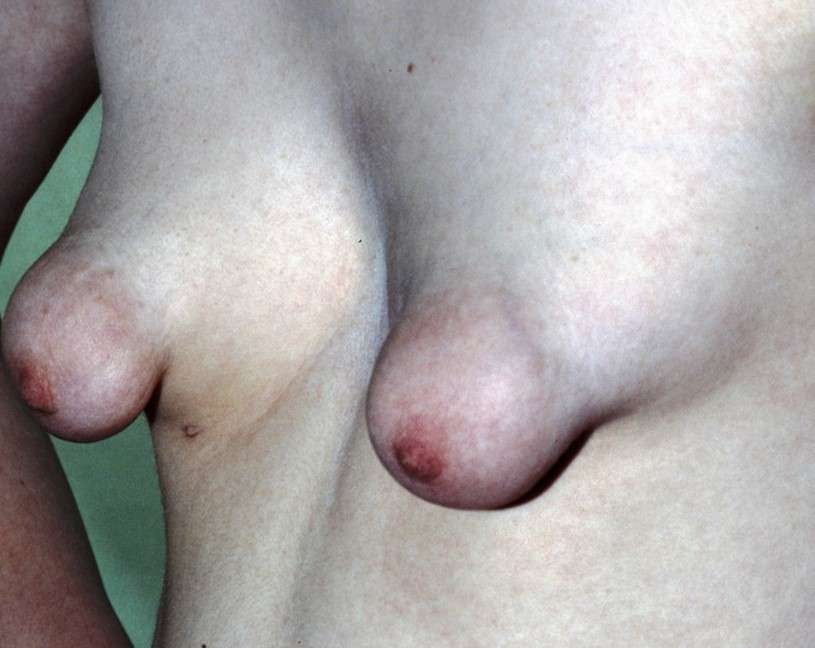Tuberous breasts (snoopy breasts) 
