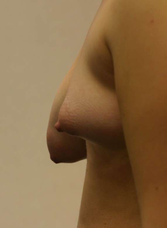 Breast asymm1.jpg 