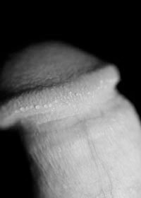 Penile papules on glans pearly Hirsuties coronae