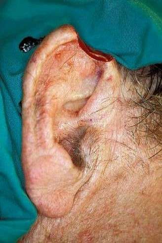Ear cancer removed
