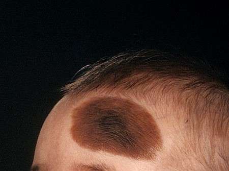 Large hairy birthmark 