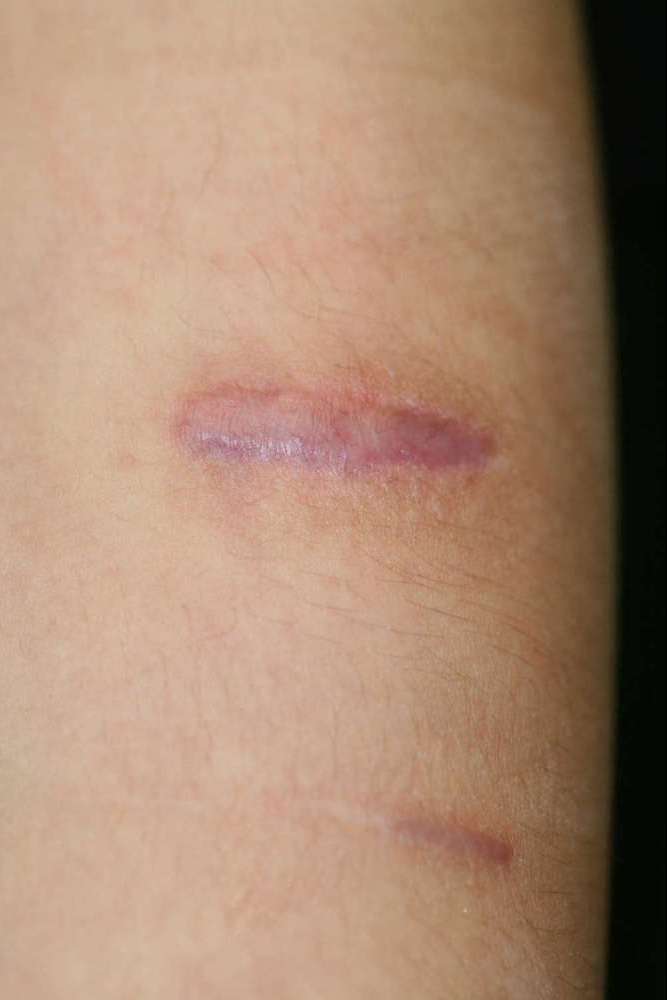 Keloid scar mid-treatment 