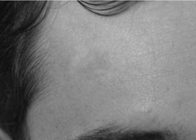 Laser treatment to remove dark birthmark