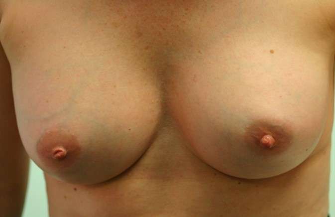 Breast enhancement