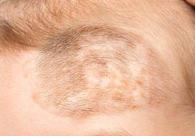 Laser treatment to remove hairy birthmarks