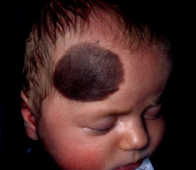 Excision_of_a_Pigmented_Birthmark_-_1.jpg 