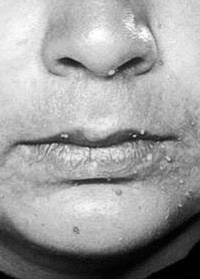 Facial warts after treatment