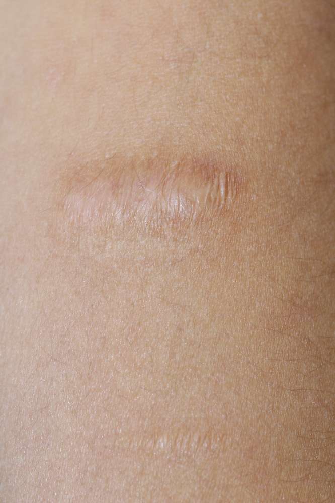 Keloid scar after treatment