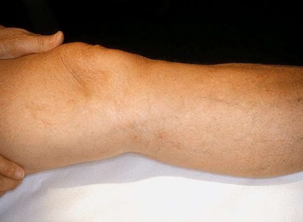 Laser removal of thread veins